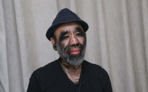 全身长满毛的毛孩于震寰曾被无数人嘲讽现生活令人羡慕