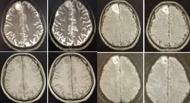 脊髓血管畸形颅内肿瘤韦尼克脑病丨3分钟读片24期