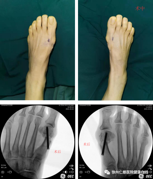 术中,c型臂定位后,手术医生先后于右足及左足第1跖趾关节近端内侧做一