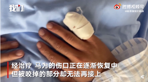 看着好疼手指被嫌疑人咬掉他说还会冲