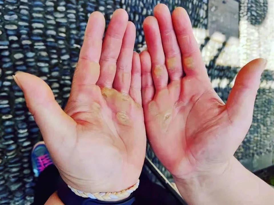 她是登上残奥会领奖台的首位东阳人用拼搏书写青春