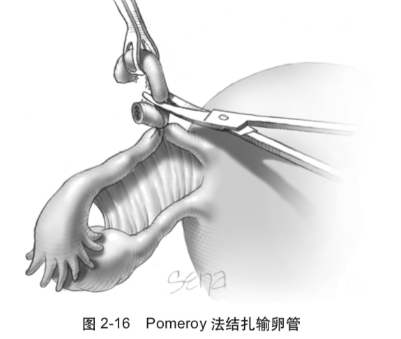 女性节育术你知道几种方法
