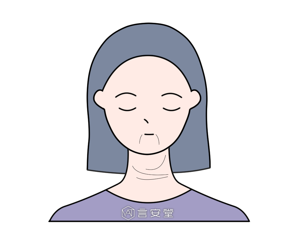 混合性的皱纹:木偶纹,颈纹,嘴角纹原因:人体老化相关预防的办法和前面