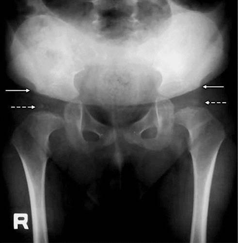 11种常见代谢性骨病的影像学表现 Qtc Care