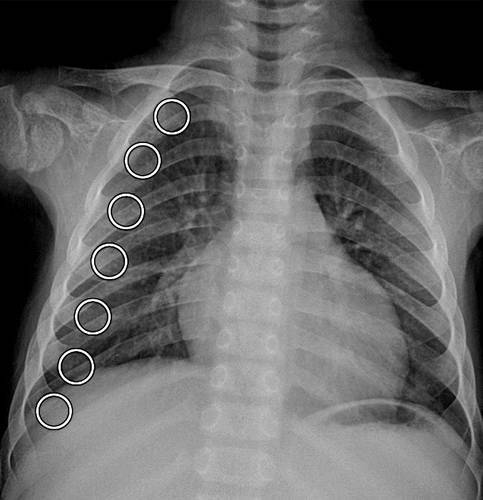 11种常见代谢性骨病的影像学表现 Qtc Care