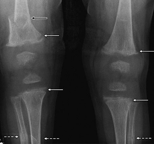 11种常见代谢性骨病的影像学表现 Qtc Care