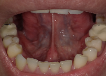宝宝舌系带短什么时候剪最好
