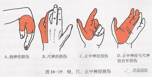 桡神经损伤治疗