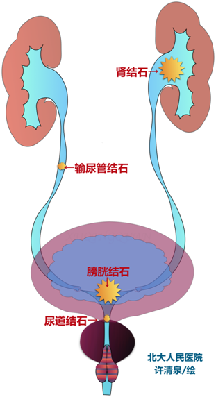 腰痛狹窄造瘻都是石頭惹的禍