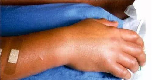 大内久:核辐射后被医生强行挽救了83天,每天看着自