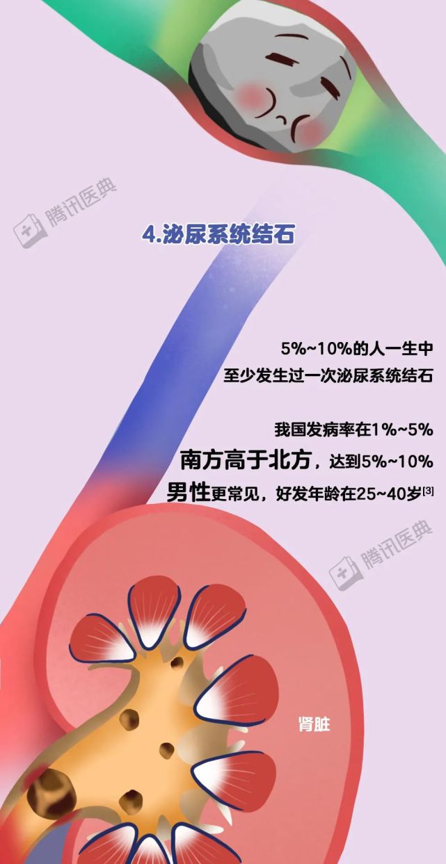 身体里为什么会长石头结石形成过程大揭秘