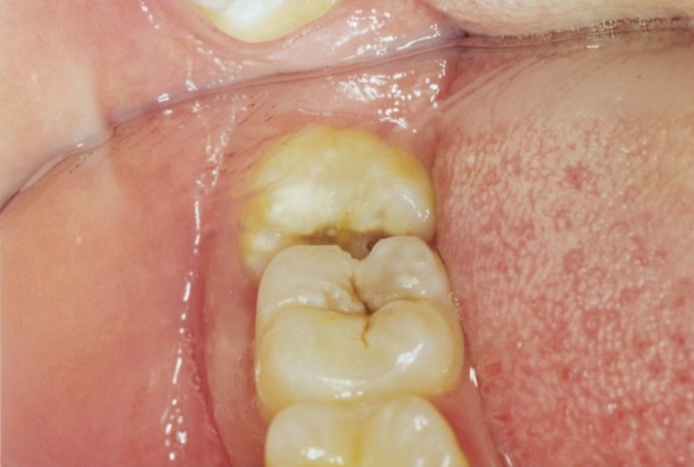 智齿长在牙龈外侧图片