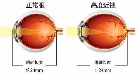 近视手术可以做两次吗 腾讯新闻