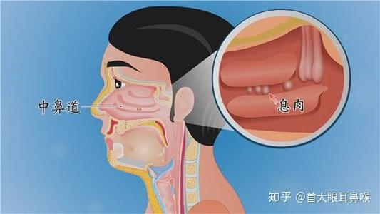 廣東崇愛康復醫院醫師教你如何在發現早期鼻息肉症狀