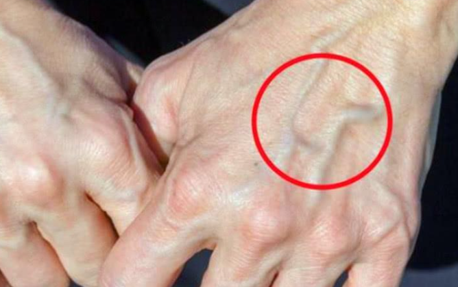 肝脏不好?看手就知道,5种异常出现,需尽快防治