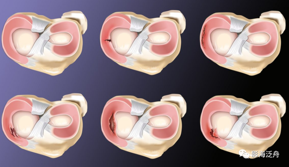 面對半月板損傷從此不再迷茫