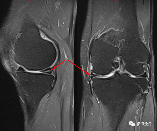 面对半月板损伤,从此不再迷茫