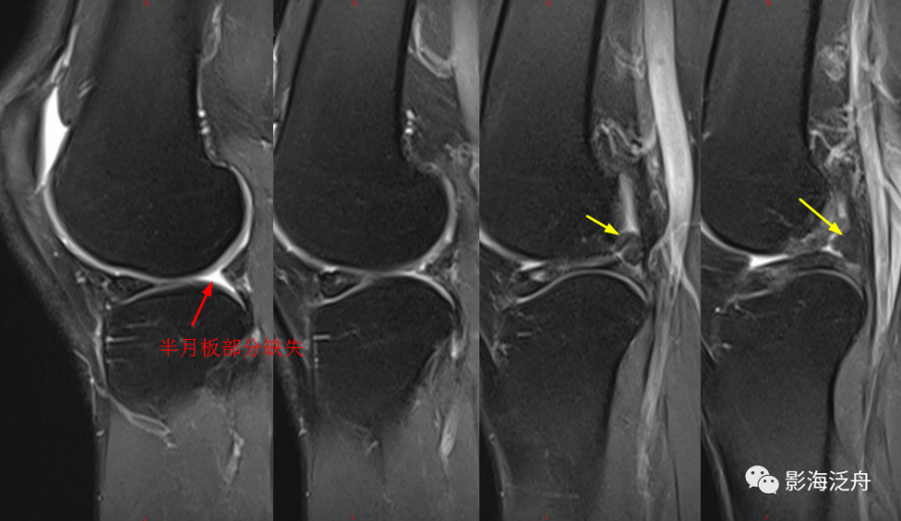 面对半月板损伤,从此不再迷茫