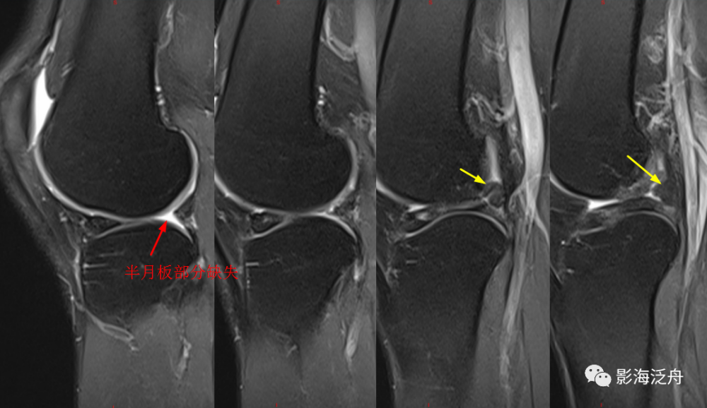 桶柄樣半月板撕裂少見,但具有一定特徵,比如前角撕裂形成的