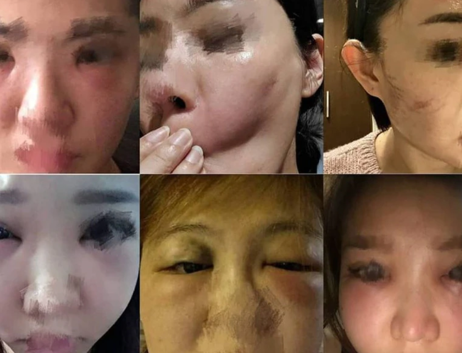 黑心美容诊所竟用仿冒玻尿酸 10名女子整容惨变凹凸脸_腾讯新闻
