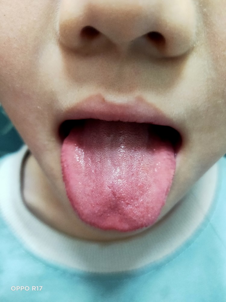 望诊:舌淡红,苔薄白小家伙高烧问诊:发烧 39℃,恶寒无汗,头痛轻微咳嗽