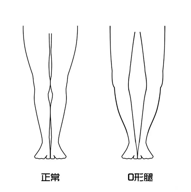 錦囊o型腿怎麼辦