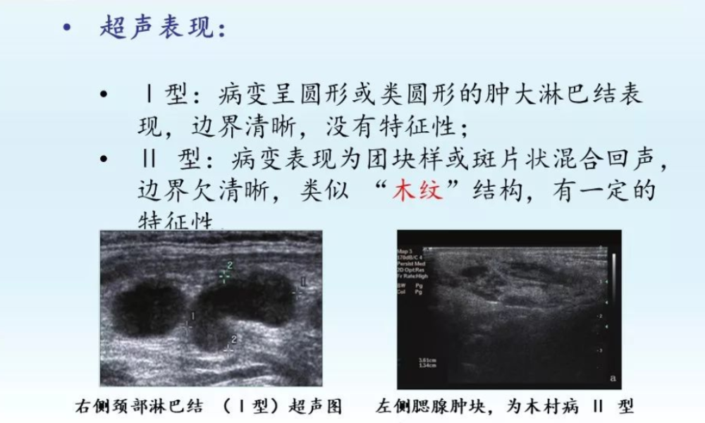 木村病是癌症吗 有哪些表现的症状 木村病如何治疗 腾讯新闻