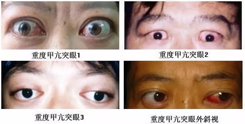 广州穗雅医院李雄主任甲亢突眼分四个等级你知道吗