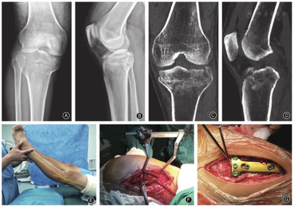 骨科小技巧 过伸双髁胫骨平台骨折的复位与固定 腾讯新闻