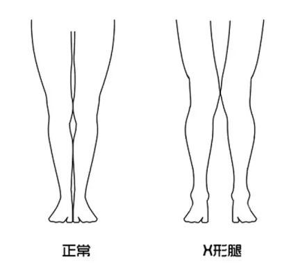 运动|搞定"下肢"问题4:破解"x型腿"