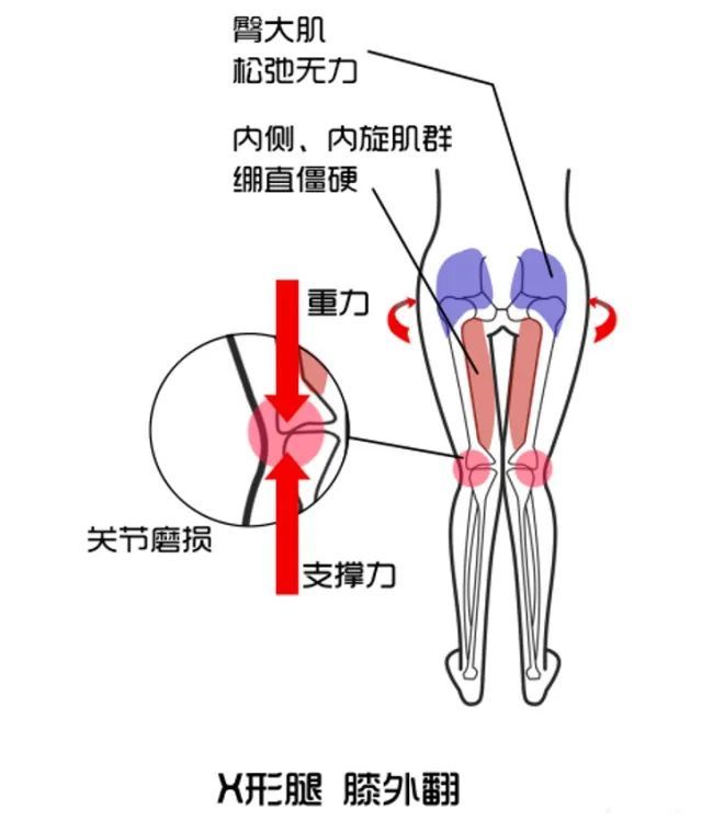 运动|搞定"下肢"问题4:破解"x型腿"