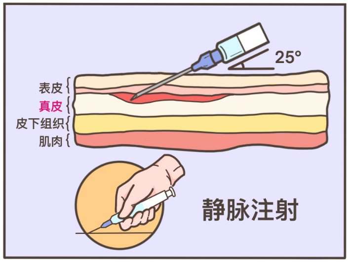 注射,斜着扎进血管里图片来源:网络请回想一下打青霉素前做的「皮试」