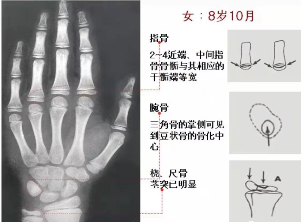 尺骨远端骨骺图片