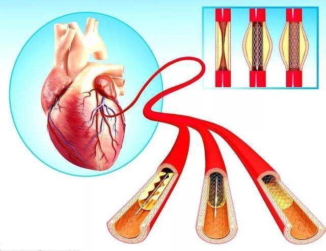 做心臟支架到底好不好放了支架後還能活多久看完你就明白了