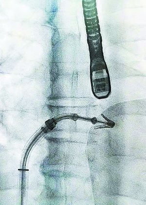 厦心王焱教授(前排左三)率团队开展二尖瓣钳夹术.(厦心供图)