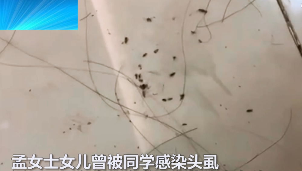网上火了梅州10岁女孩染头虱各种方法去不掉妈妈热夹板烫出20多少只