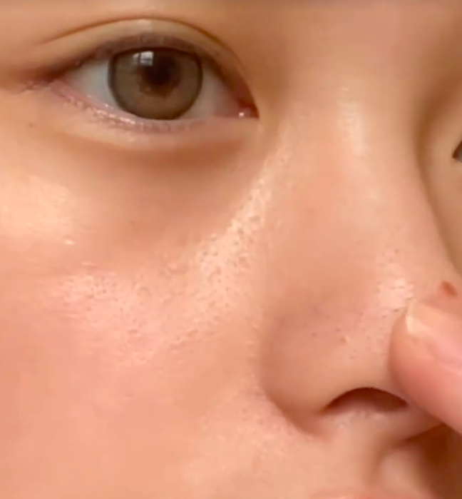 闭口粉刺跟鸡皮肤的区别(闭口粉刺跟鸡皮肤的区别图片)