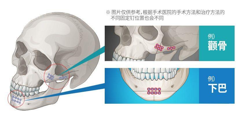 頂級神顏都要悄悄do這顴骨顴弓內推這麼神