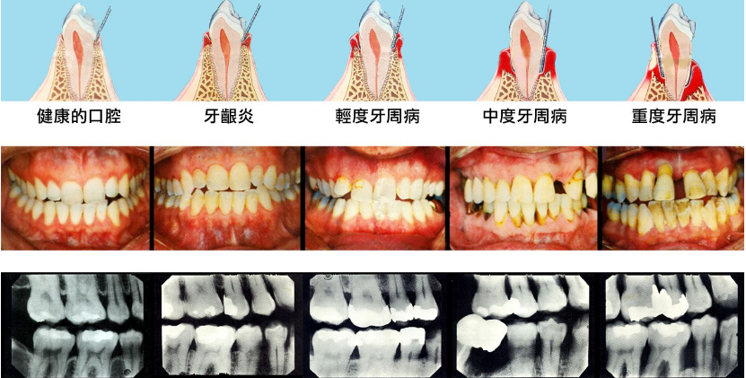 其實就是後槽牙沒有完全的萌出,一部分牙齒還在牙齦之中