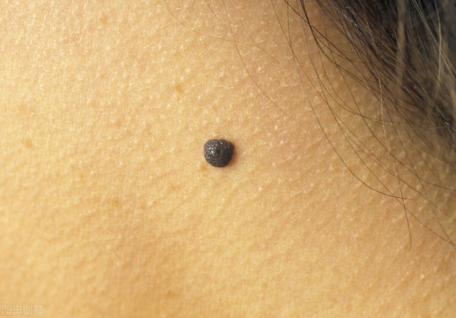 别错把癌症当黑痣对照身上的痣5种方法教会你辨别