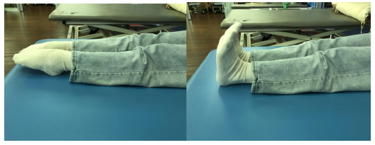 髌骨骨折后应注意什么