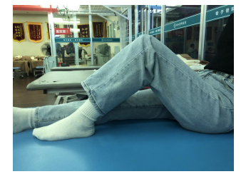 髌骨骨折后应注意什么