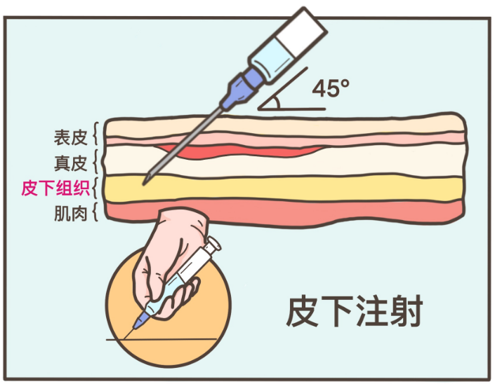 2,皮下注射,有一点点酸爽我们自小打过的吊针,每次体检的抽血,都是