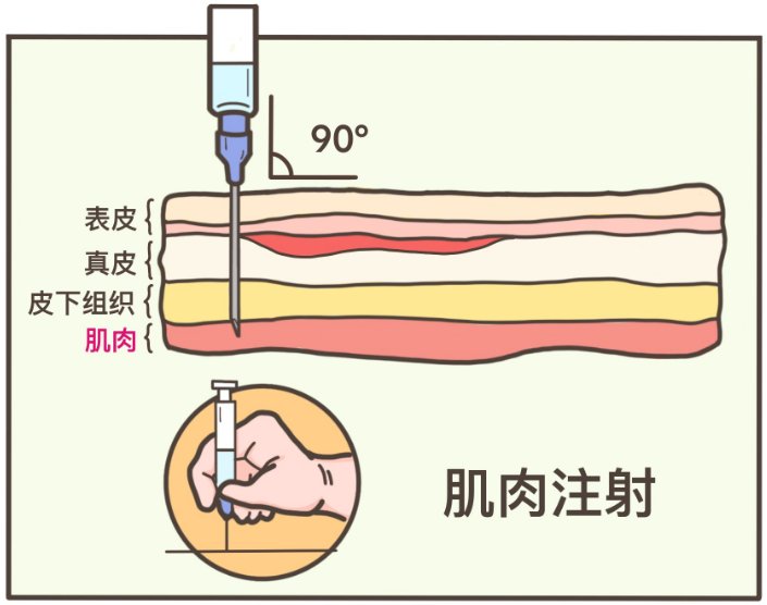 4,肌肉注射,垂直进针最不疼虽然不会被痛哭,但还是会让人忍不住龇牙