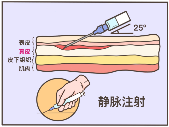 注射,斜着扎进血管里图片来源于网络请回想一下打青霉素前做的"皮试"