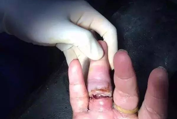 但是戒指虽美也不能是这么个戴法啊十根手指竟然被卡住了7个手指被