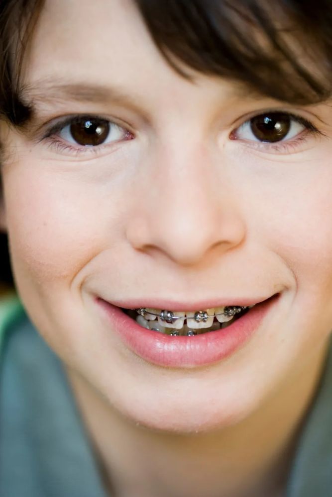 带牙套=变美?牙齿矫正挺"挑人"!