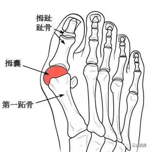 常穿高跟鞋謹防拇外翻畸形