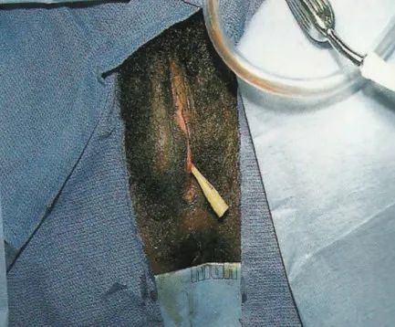 2008;28(2):161-165怎么区分前庭大腺脓肿和前庭大腺囊肿前庭大腺