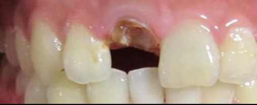 镶牙时牙根要不要拔?